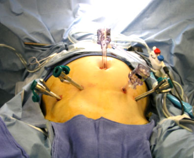 Nationwide minimally invasive surgery rates triple for pancreatic disease