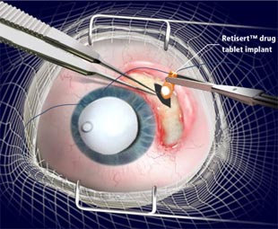 Steroid implant eye